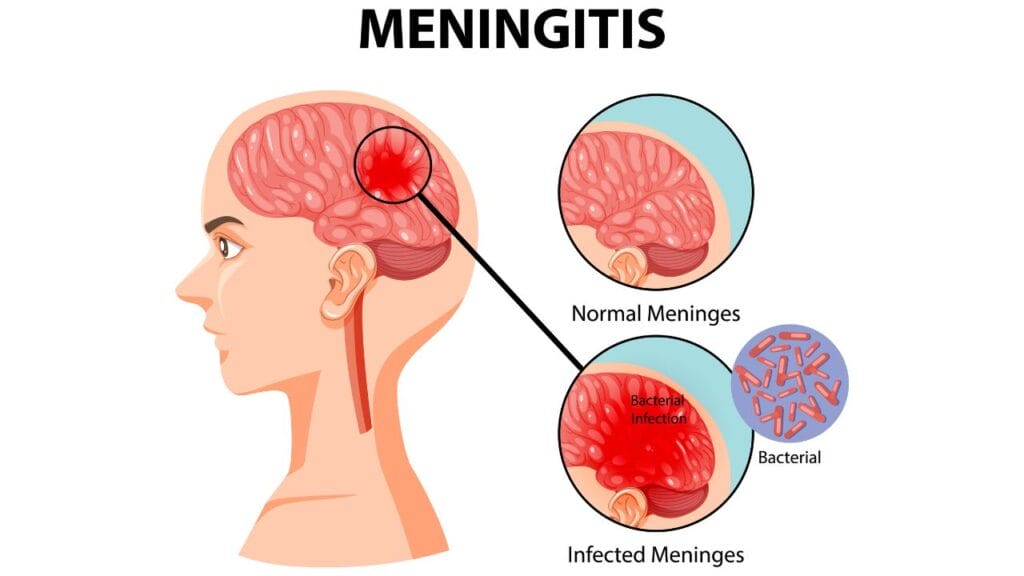 “Meningitis: Gejala, Risiko, dan Pencegahan yang Wajib Anda Ketahui”