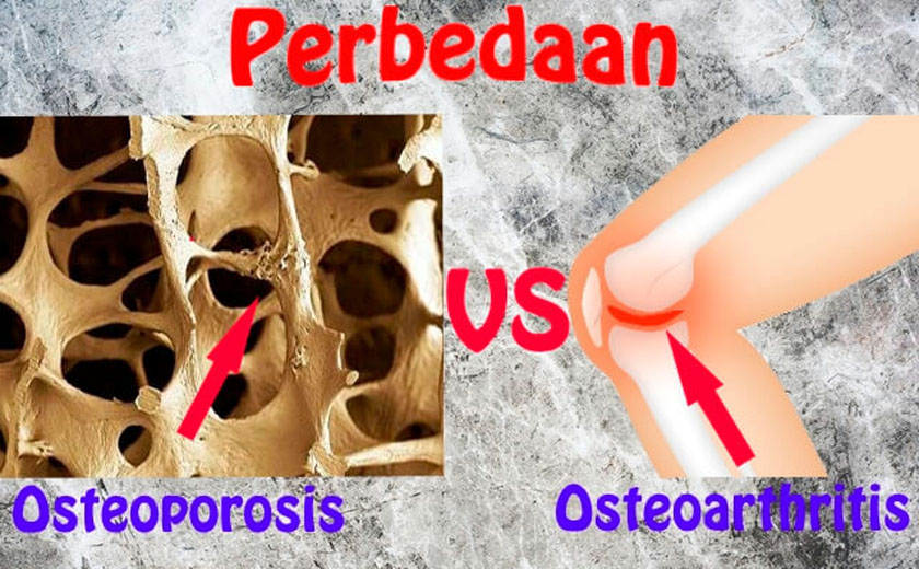 Tulang Rapuh dan Sendi Nyeri: Waspadai Osteoporosis dan Osteoartritis