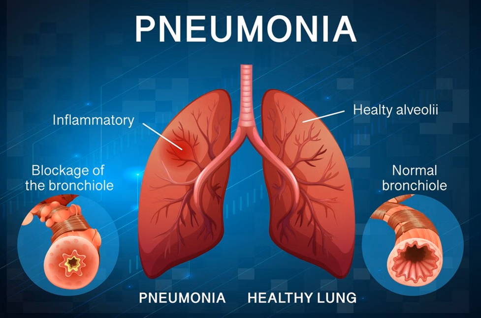 Radang Paru (Pneumonia): Ancaman Kesehatan yang Wajib Diwaspadai
