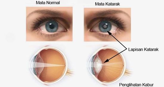 Katarak: Penyakit Mata yang Perlahan Mengaburkan Dunia Anda