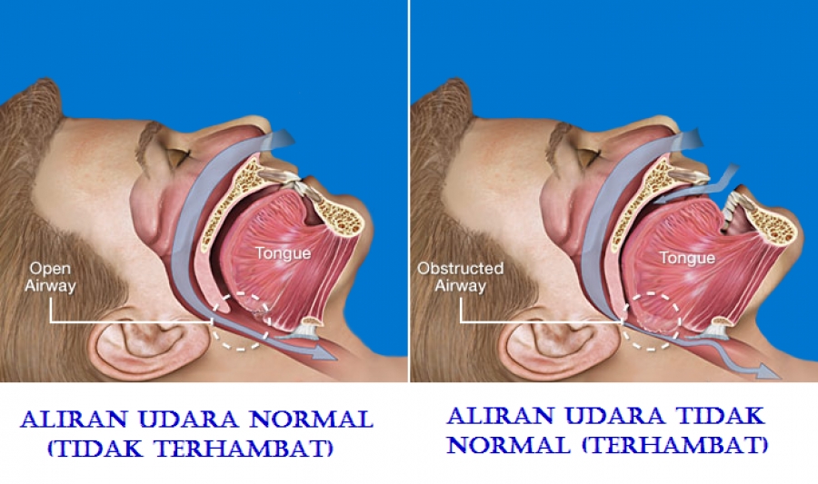 Apakah Ngorok Termasuk Penyakit? Ini Fakta Medis yang Jarang Diketahui