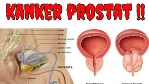 “Waspada! Penyebab Kanker Prostat yang Sering Diabaikan Pria”