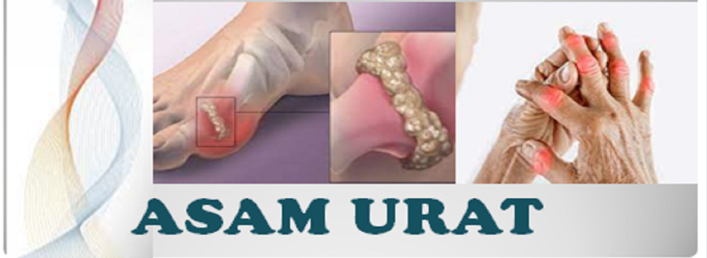 Gaya Hidup dan Penyebab Asam Urat yang Perlu Dihindari