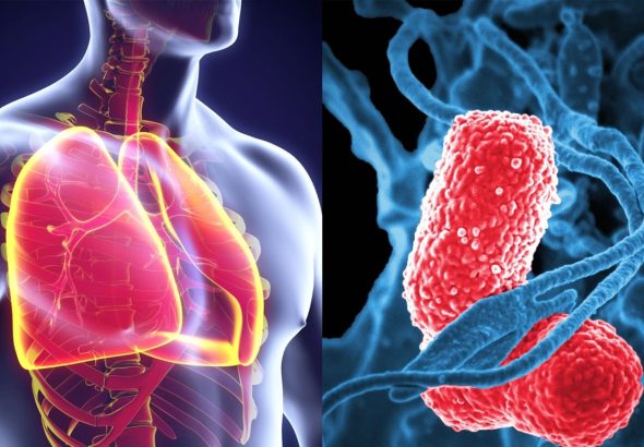 Waspada Paru-Paru Basah: Penyebab, Gejala, dan Risiko Kematian