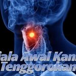 6 Gejala Awal Kanker Tenggorokan yang Harus Diwaspadai