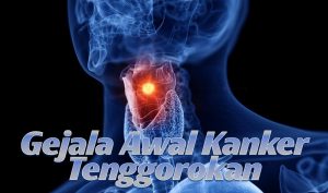 6 Gejala Awal Kanker Tenggorokan yang Harus Diwaspadai