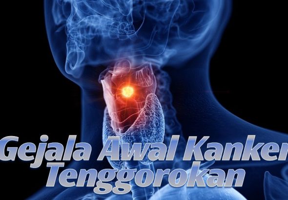 6 Gejala Awal Kanker Tenggorokan yang Harus Diwaspadai