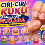Jangan Abaikan, Ini 12 Perubahan Kuku yang Bisa Berkaitan dengan Gangguan Ginjal