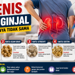 4 Jenis Batu Ginjal yang Sering Menyerang, Ketahui Cara Mencegahnya