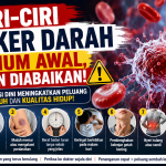 7 Ciri-Ciri Kanker Darah Stadium Awal